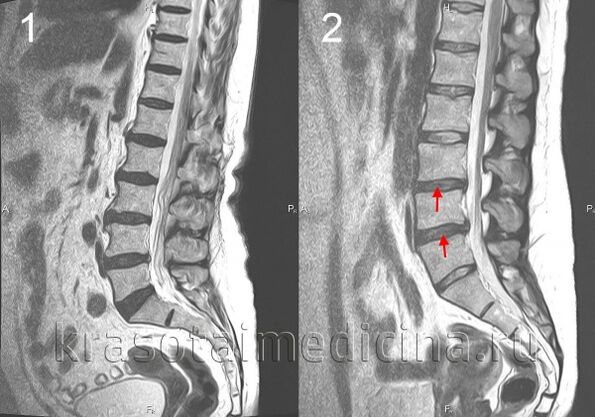 Osteochondrose van de wervelkolom