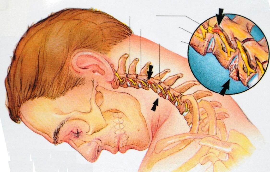 Osteochondrose van het cervicale gebied